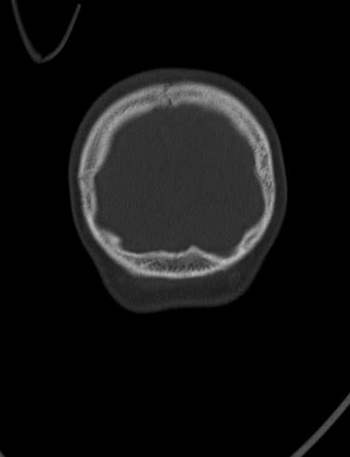 Acute mastoiditis (Radiopaedia 82678-96881 Coronal bone window 76).jpg