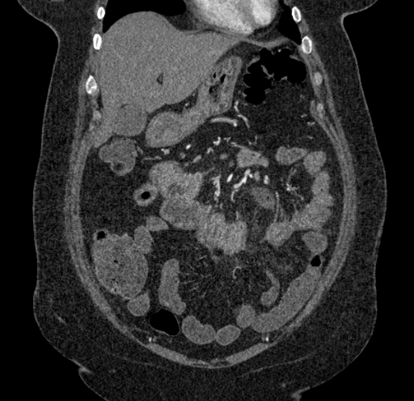 Acute mesenteric ischemia (Radiopaedia 80029-93316 Coronal C+ arterial phase 34).jpg
