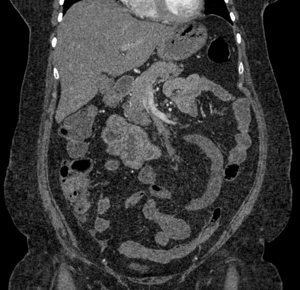 Acute mesenteric ischemia (Radiopaedia 80029-93316 Coronal C+ arterial phase 52).jpg