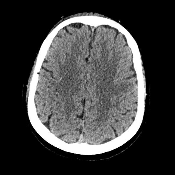Acute middle cerebral artery territory infarct (Radiopaedia 52380-58283 Axial non-contrast 75).jpg