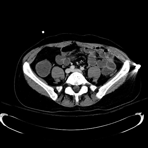 Acute myocardial infarction in CT (Radiopaedia 39947-42415 Axial C+ portal venous phase 87).jpg