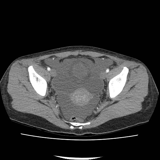 File:Acute myocarditis (Radiopaedia 55988-62613 Axial C+ portal venous phase 70).jpg