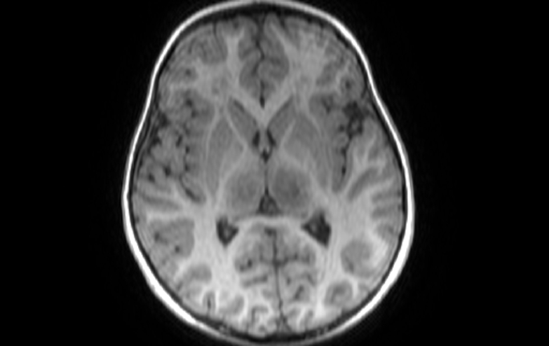 File:Acute necrotizing encephalitis of childhood (Radiopaedia 67356-76737 Axial T1 46).jpg