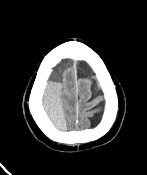 Acute on chronic subdural hematoma (Radiopaedia 78346-90966 Axial non-contrast 50).jpg