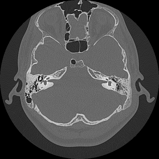 Acute otomastoiditis and Bezold abscess (Radiopaedia 88184-104786 Axial bone window 36).jpg