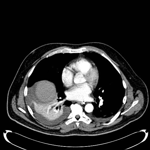 File:Acute pancreatic necrosis (Radiopaedia 13560-18500 Axial C+ portal venous phase 5).jpg