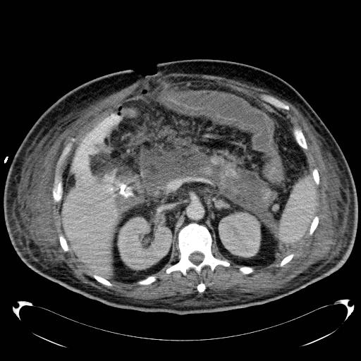 Acute pancreatic necrosis (Radiopaedia 13560-18503 Axial C+ portal venous phase 27).jpg