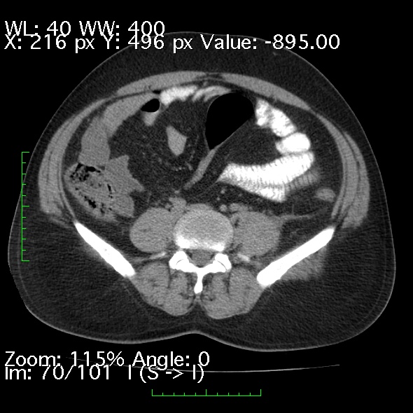 Acute pancreatitis (Radiopaedia 34043-35276 Axial non-contrast 70).jpg