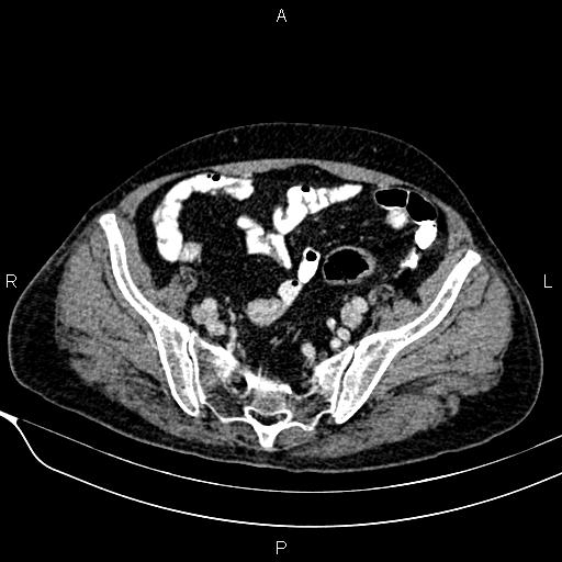 Acute pancreatitis (Radiopaedia 85146-100701 Axial C+ portal venous phase 52).jpg