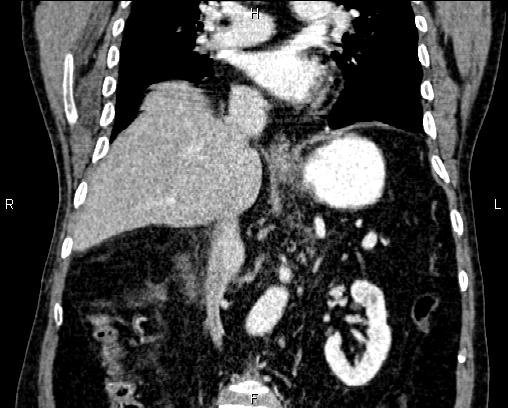 Acute pancreatitis (Radiopaedia 85146-100701 Coronal C+ portal venous phase 43).jpg