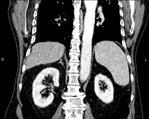 Acute pancreatitis (Radiopaedia 85146-100701 Coronal C+ portal venous phase 53).jpg