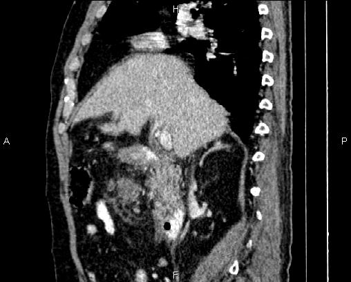 File:Acute pancreatitis (Radiopaedia 85146-100701 Sagittal C+ portal venous phase 34).jpg