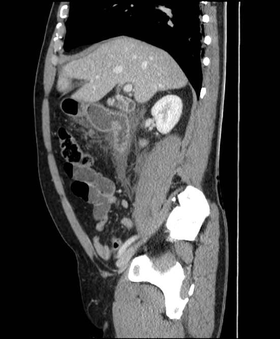 Acute pancreatitis - Balthazar E (Radiopaedia 23080-23110 Sagittal C+ portal venous phase 31).jpg