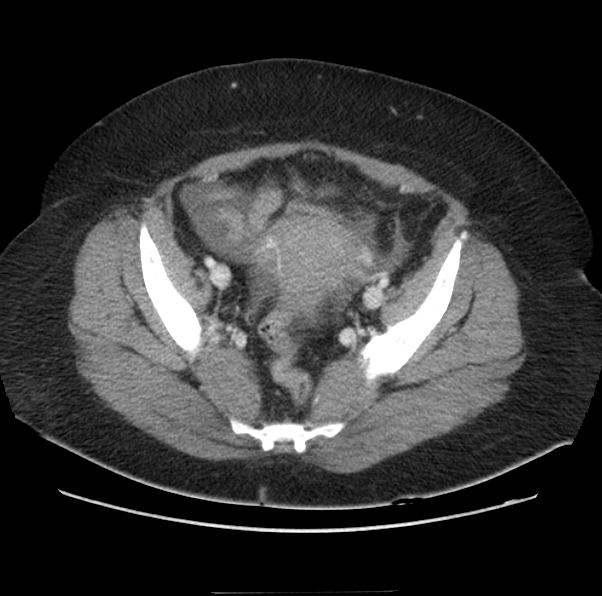 Acute pancreatitis - Balthazar E (Radiopaedia 29016-29377 Axial C+ portal venous phase 62).png