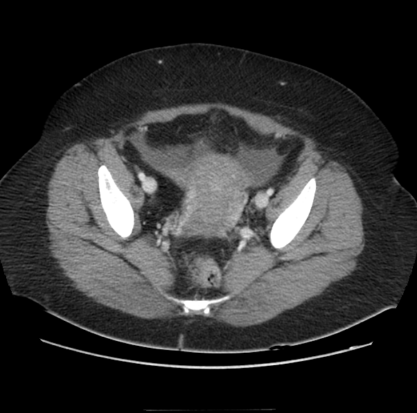 Acute pancreatitis - Balthazar E (Radiopaedia 29016-29377 Axial C+ portal venous phase 64).png