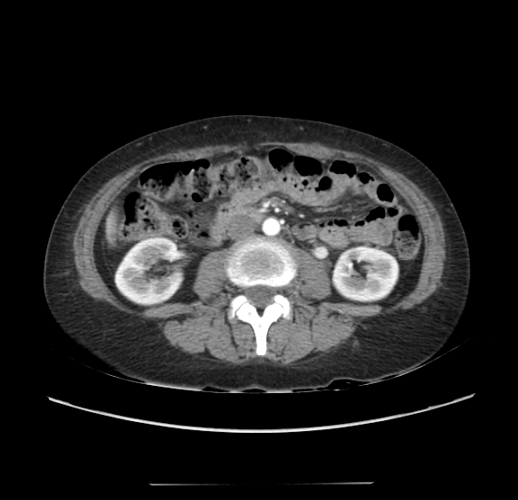 File:Acute pancreatitis - Balthazar E - post ERCP (Radiopaedia 27562-27772 Axial C+ arterial phase 31).png