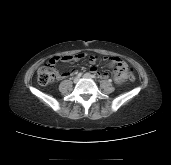 File:Acute pancreatitis - Balthazar E - post ERCP (Radiopaedia 27562-27772 Axial C+ portal venous phase 48).png