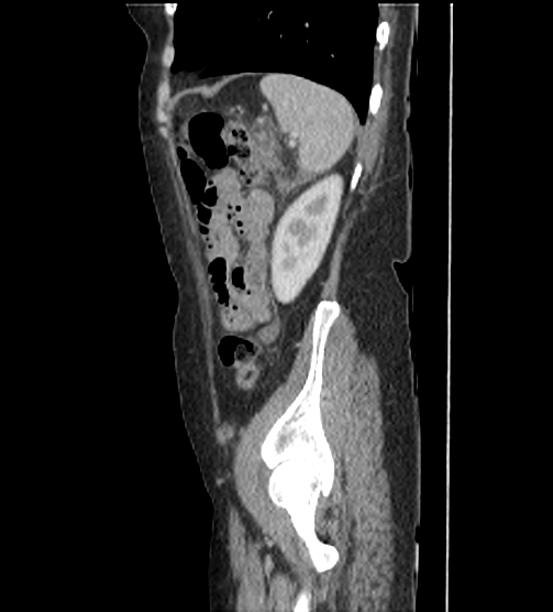 Acute pancreatitis - Balthazar E - post ERCP (Radiopaedia 27562-27772 Sagittal C+ portal venous phase 110).png