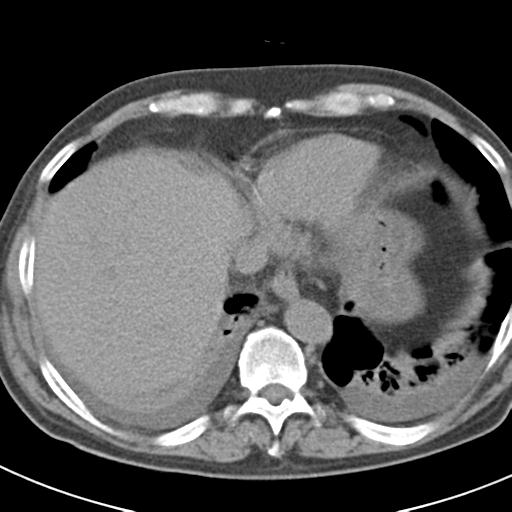 File:Acute pancreatitis and walled-off necrosis (Radiopaedia 29888-30403 Axial non-contrast 6).jpg