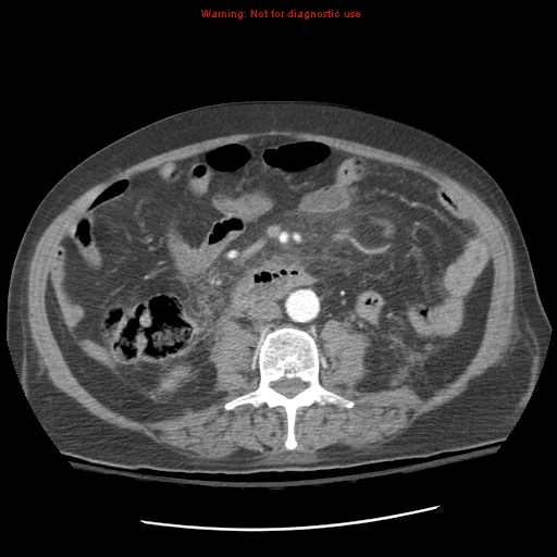 Acute pancreatitis with incidental pancreatic lipoma (Radiopaedia 10190-10730 Axial C+ arterial phase 58).jpg