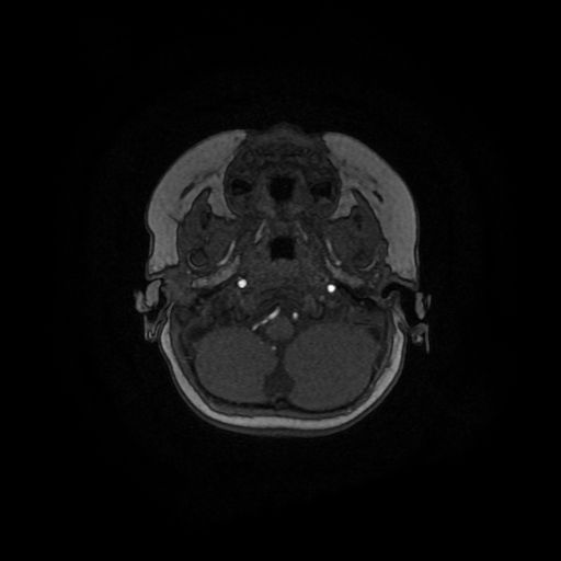 Acute phase of hemiconvulsion-hemiplegia epilepsy syndrome (Radiopaedia 29309-29745 Axial TOF angiography 140).jpg