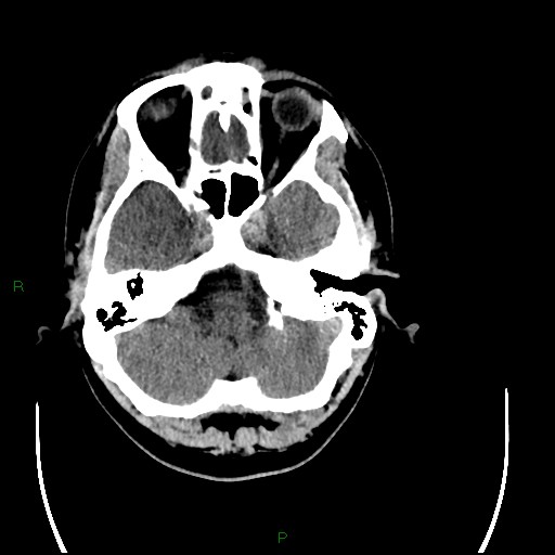 File:Acute posterior cerebral artery territory infarct (Radiopaedia 79329-92393 Axial non-contrast 22).jpg