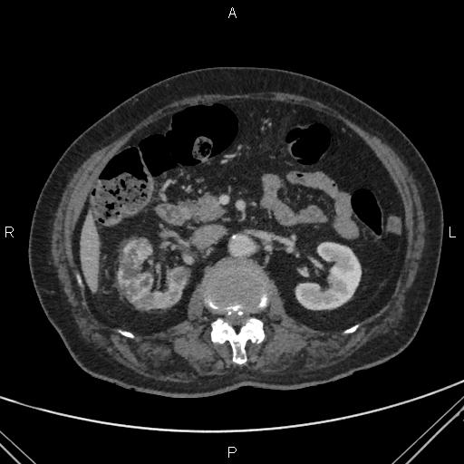 File:Acute renal artery occlusion (Radiopaedia 86586-102682 Axial C+ portal venous phase 31).jpg