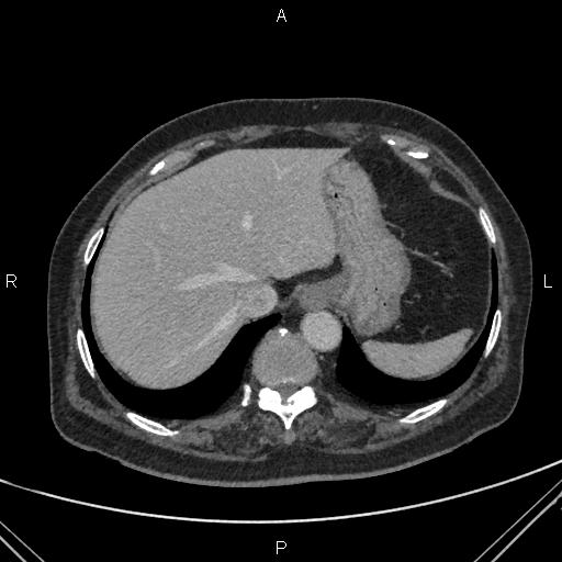 Acute renal artery occlusion (Radiopaedia 86586-102682 Axial C+ portal venous phase 7).jpg