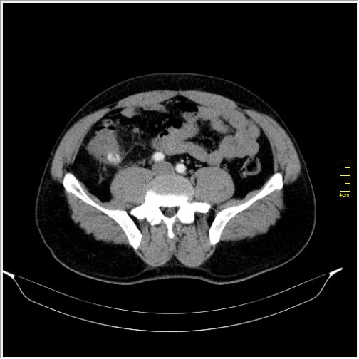 Acute right sided diverticulitis (Radiopaedia 65249-74268 Axial C+ portal venous phase 52).JPG