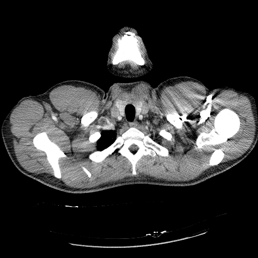 Acute segmental pulmonary emboli and pulmonary infarction (Radiopaedia 62264-70444 Axial C+ CTPA 11).jpg
