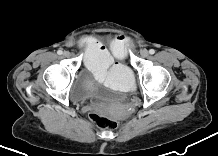 Acute small bowel (ileal) volvulus (Radiopaedia 71740-82139 Axial C+ portal venous phase 183).jpg