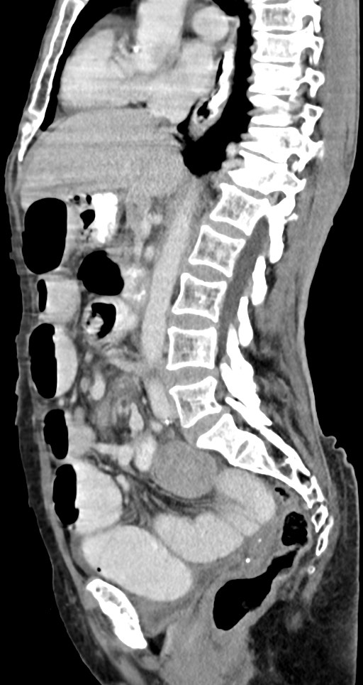 Acute small bowel (ileal) volvulus (Radiopaedia 71740-82139 Sagittal C+ portal venous phase 91).jpg