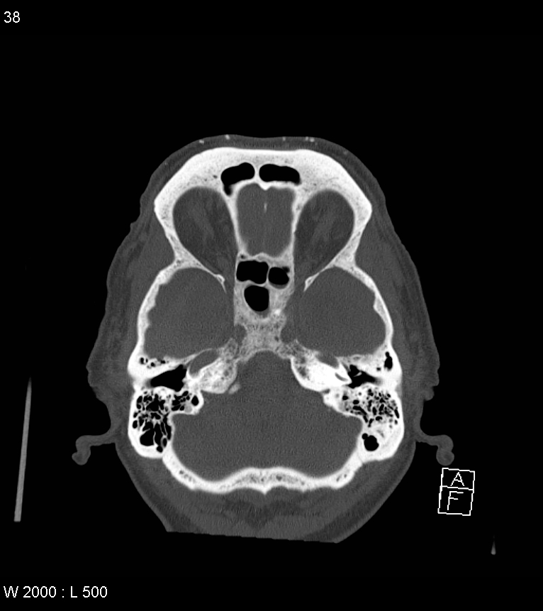 Acute subdural hematoma with myelofibrosis (Radiopaedia 52582-58494 Axial bone window 19).jpg