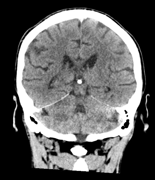 File:Acute superior cerebellar artery territory infarct (Radiopaedia 84104-99359 Coronal non-contrast 59).jpg