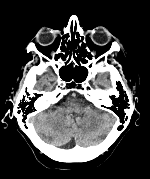 Acute traumatic subdural hematoma (Radiopaedia 82921-97257 Axial non-contrast 49).jpg