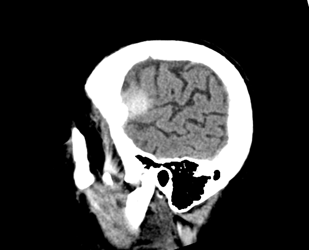 Acute traumatic subdural hematoma (Radiopaedia 82921-97257 Sagittal non-contrast 16).jpg
