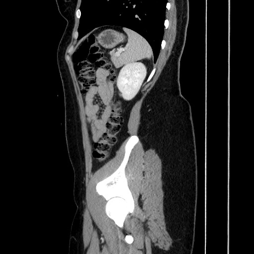 Acute uncomplicated appendicitis (Radiopaedia 73704-84499 Sagittal C+ portal venous phase 153).jpg