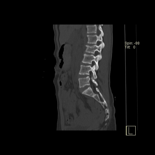 File:Acute vertebral compression fracture (Radiopaedia 63832-72559 Sagittal bone window 17).jpg