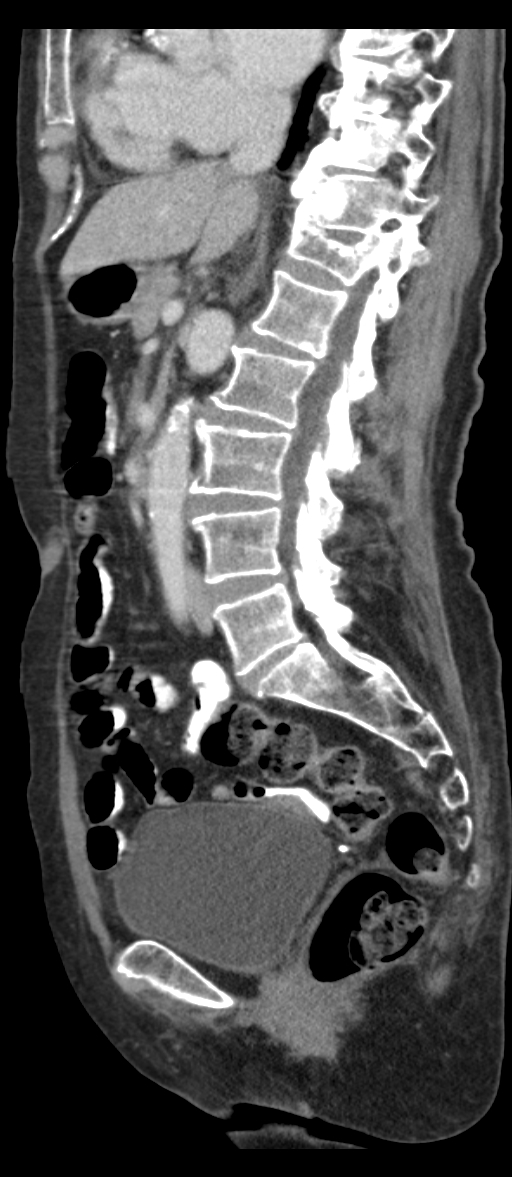Adenocarcinoma of cecum (Radiopaedia 59222-66549 Sagittal C+ portal venous phase 49).jpg