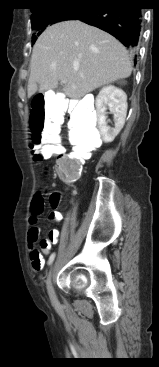 Adenocarcinoma of pancreas with hepatic metastasis (Radiopaedia 64332-73122 Axial C+ portal venous phase 37).jpg
