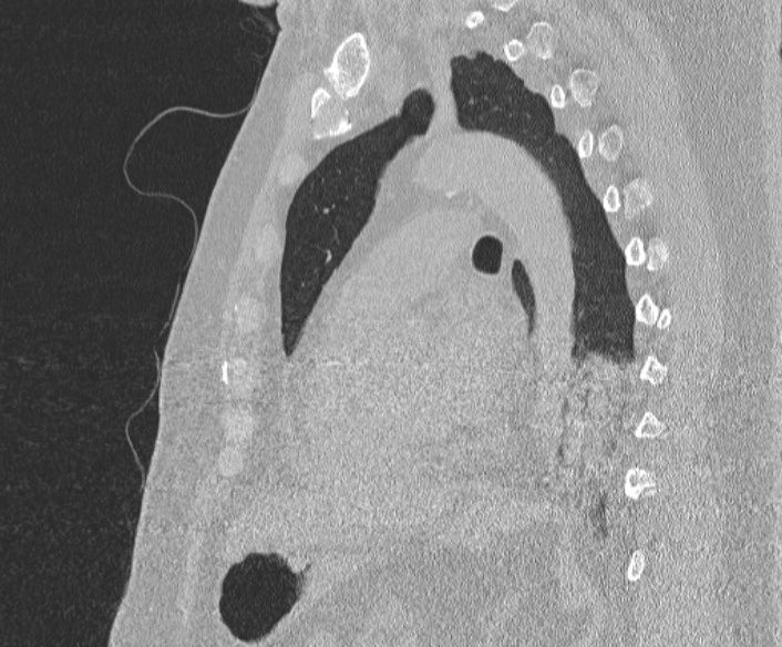 Adenoid cystic carcinoma of the trachea (Radiopaedia 49042-54137 Sagittal lung window 279).jpg