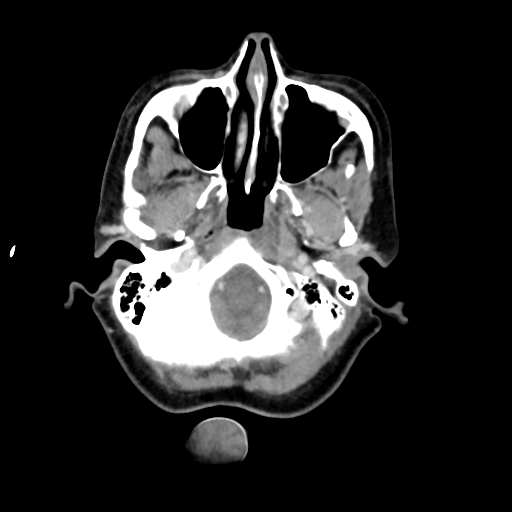 File:Adenoid cystic tumor of palate (Radiopaedia 46980-51518 Axial C+ delayed 20).png