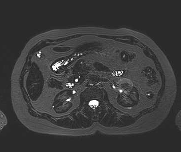 File:Adenomyomatosis of the gallbladder (Radiopaedia 50246-55587 Axial 27).png