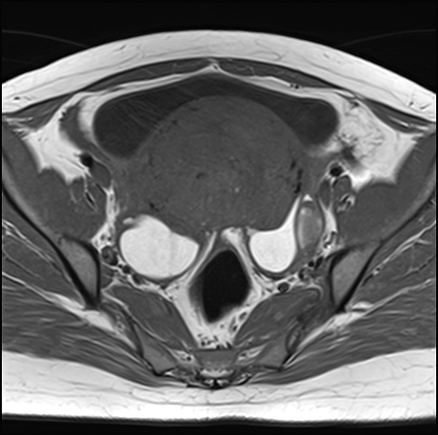 File:Adenomyosis - ovarian endometriomas (Radiopaedia 67031-76350 Axial T1 13).jpg