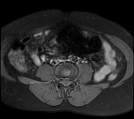 File:Adenomyosis - ovarian endometriomas (Radiopaedia 67031-76350 Axial T1 C+ fat sat 1).jpg