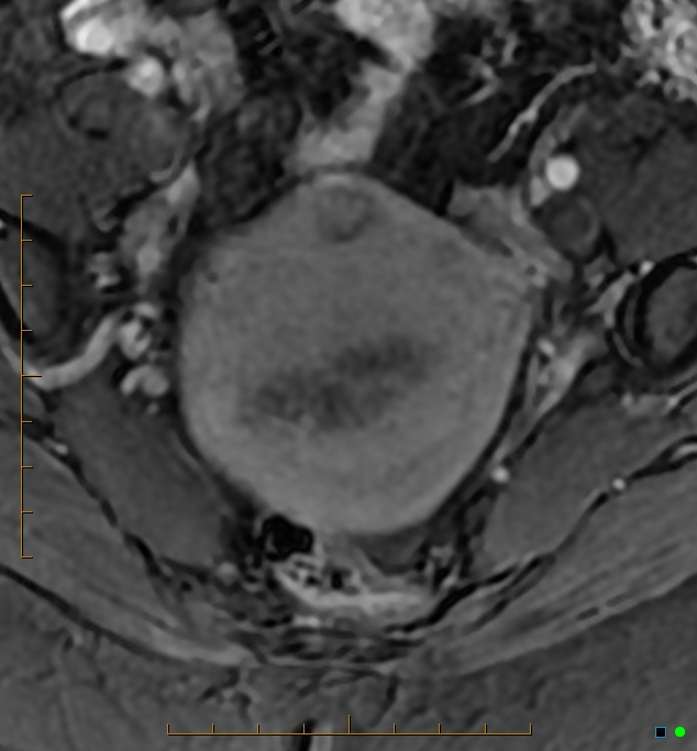Adenomyosis uterus with hematometra (Radiopaedia 45779-50011 Axial T1 C+ fat sat 14).jpg