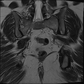 File:Adnexal multilocular cyst (O-RADS US 3- O-RADS MRI 3) (Radiopaedia 87426-103754 Coronal T2 25).jpg