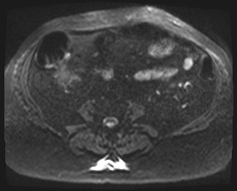 Adrenal cortical carcinoma (Radiopaedia 64017-72770 Axial DWI 82).jpg