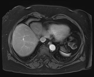 Adrenal cortical carcinoma (Radiopaedia 64017-72770 I 6).jpg