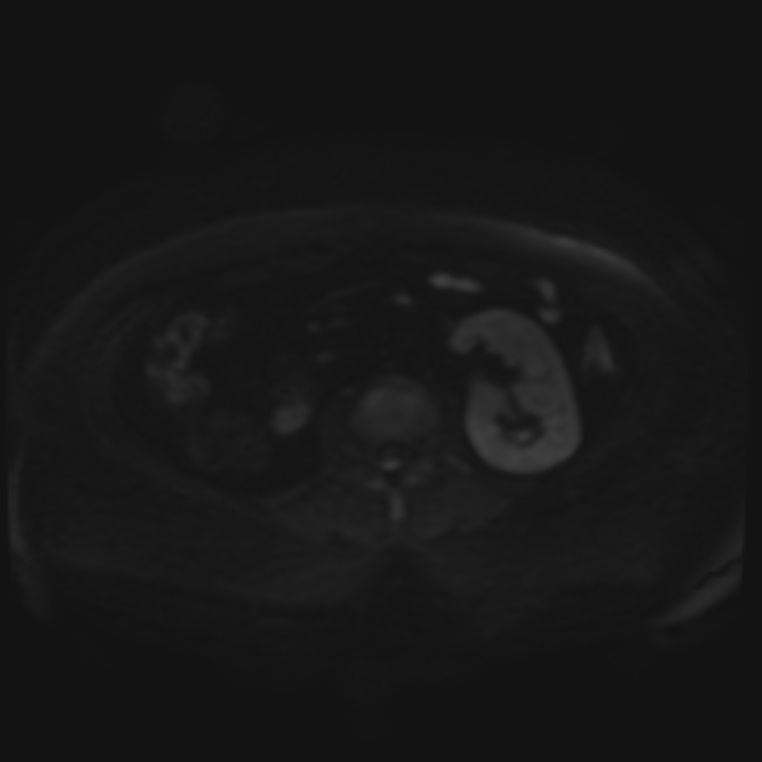 Adrenal cortical carcinoma (Radiopaedia 70906-81116 Axial DWI 50).jpg
